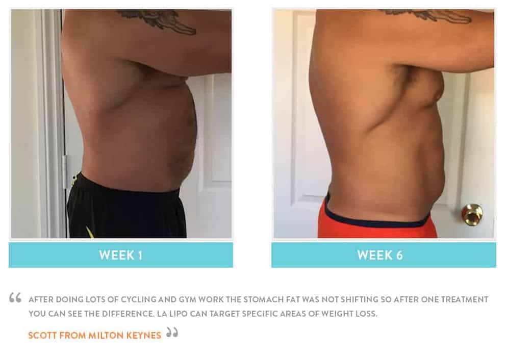 Before & After Stomach Fat Newcastle upon Tyne