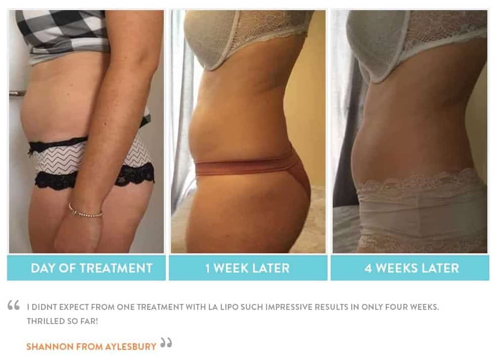 before, Cryolipolysis Newcastle upon Tyne
