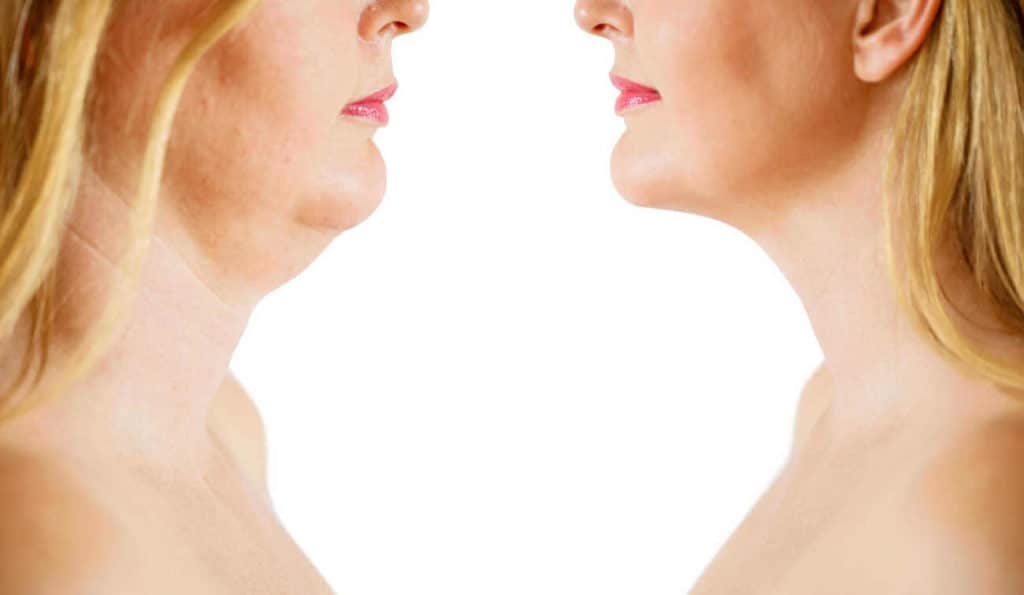 Double Chin treatment Newcastle upon Tyne before and after results