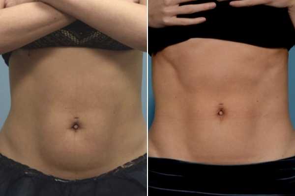 body sculpting FAQs Newcastle upon Tyne