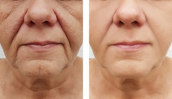 Learn more about Morpheus8 Treatment Newcastle upon Tyne today!