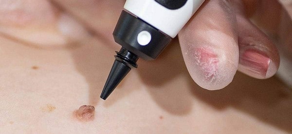 After Skin Tag Removal Newcastle upon Tyne