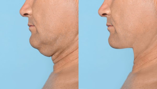 Which Non-Surgical Treatments Work Best for Jowls and Loose Skin Newcastle upon Tyne?