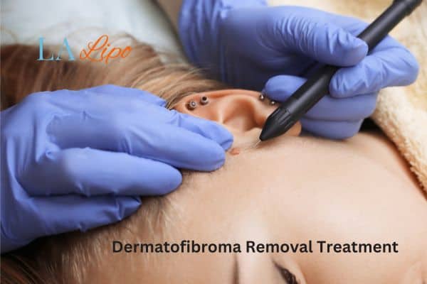 Dermatofibroma Removal Treatment Newcastle upon Tyne