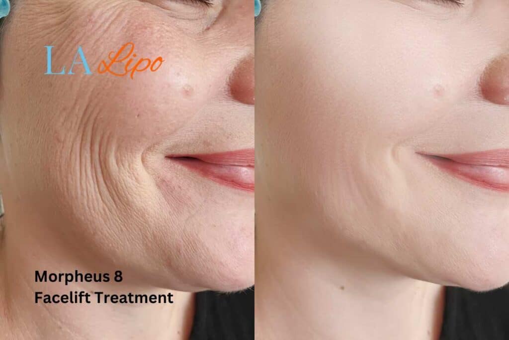 Morpheus8 Treatment Newcastle upon Tyne for flawless skin! Call us today!