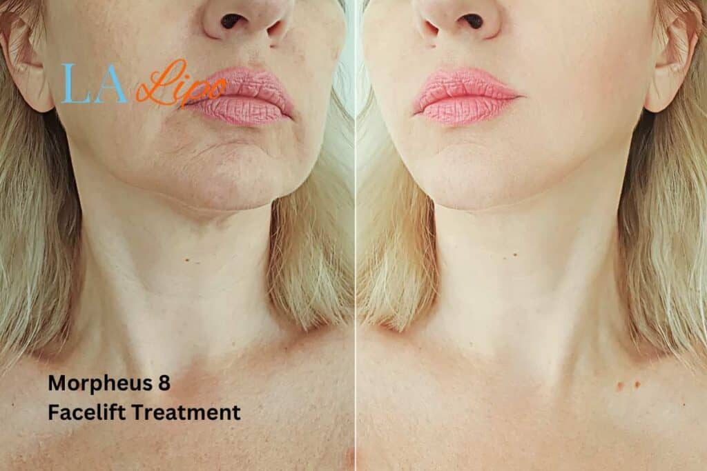 Turn back time with Morpheus8 Treatment Newcastle upon Tyne