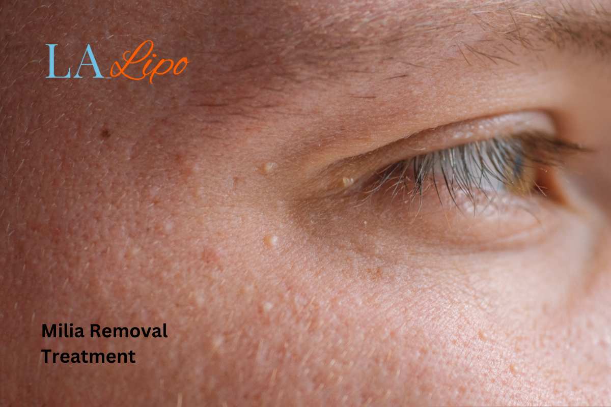 Cryopen Milia Removal: Is It the Easiest and Safest Option Newcastle upon Tyne?
