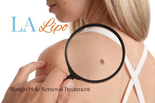 Why getting moles removed Newcastle upon Tyne can boost your confidence!