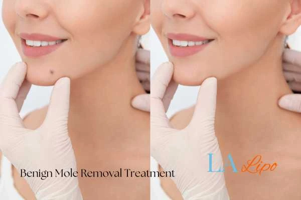 Woman's before and after results of being moles removal treatment Newcastle upon Tyne