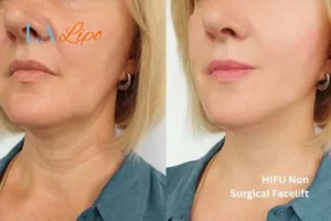 hi-fu for wrinkles Newcastle upon Tyne before and after results