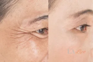 Before and after results of woman - HI-fu wrinkles reduction treatment Newcastle upon Tyne