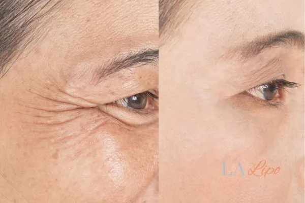 Before and after results of woman - HI-fu wrinkles reduction treatment Newcastle upon Tyne