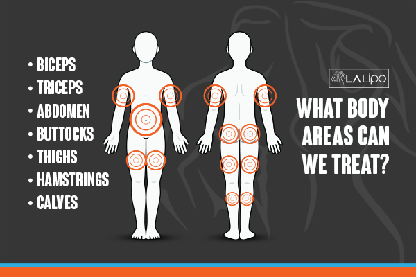 Graphic to show areas you can have LA-EMS Body Sculpting Newcastle upon Tyne treatment.