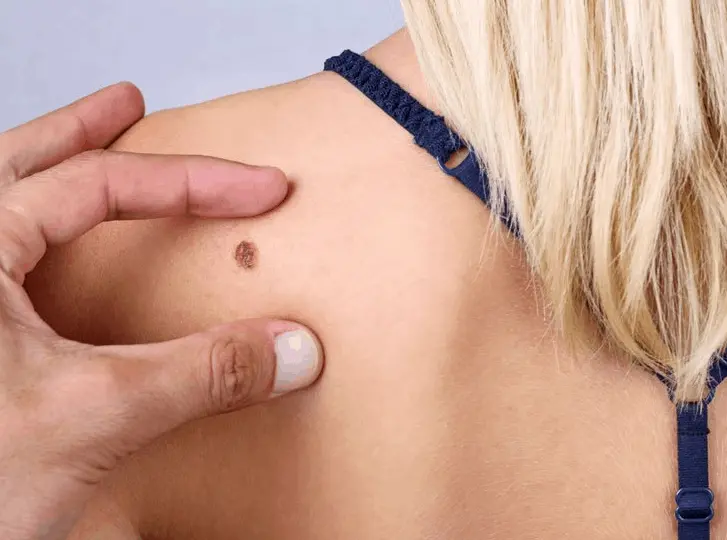 woman having mole removal Newcastle upon Tyne consultation before treatment.