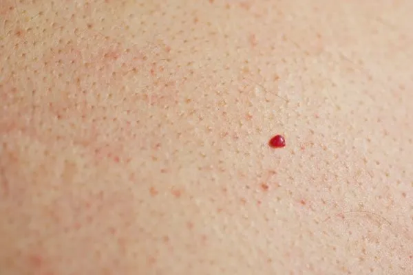 close up of a cherry angioma Newcastle upon Tyne