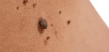 image of a skin tag Newcastle upon Tyne