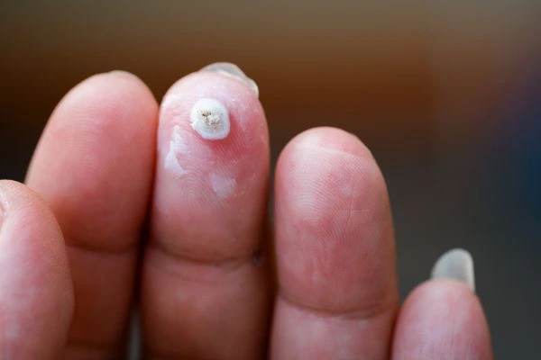wart on person finger - cryotherapy to treat from LA LIPO Newcastle upon Tyne