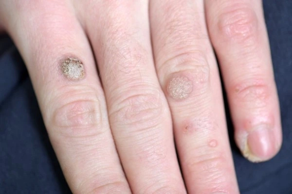 photo of warts on person hand - see wart removal Newcastle upon Tyne from LA LIPO