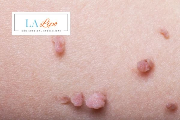 Does cryopen skin tag removal Newcastle upon Tyne hurt? Find out now call our team today!