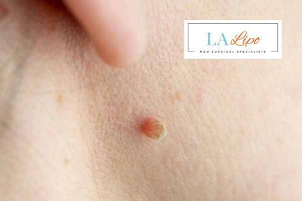 Book skin tag removal Newcastle upon Tyne today speak to our team now!
