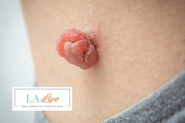 Interested in skin tag removal Newcastle upon Tyne? Concerned about the pain? Find out more today!