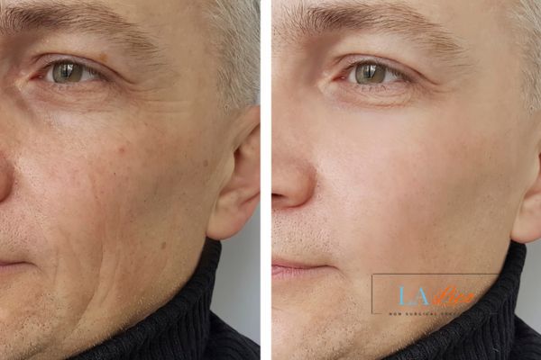 See the amazing results of Morpheus8 Treatment Newcastle upon Tyne!