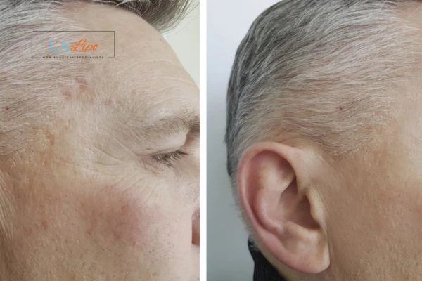 Mens Before & After Morpheus 8 Results Newcastle upon Tyne