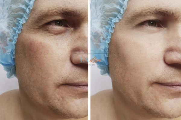 Before and after Morpheus 8 Results Newcastle upon Tyne