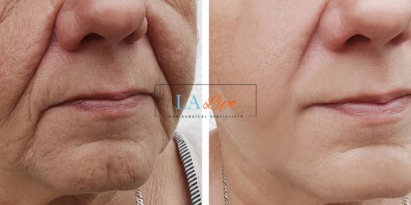 Older lady deeper wrinkle reduction - LA LIPO Morpheus 8 Results Newcastle upon Tyne