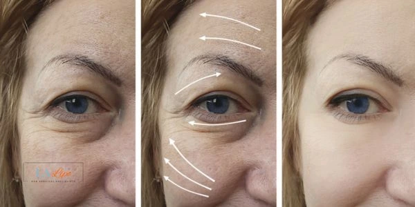 Amazing eye lift Morpheus 8 results Newcastle upon Tyne