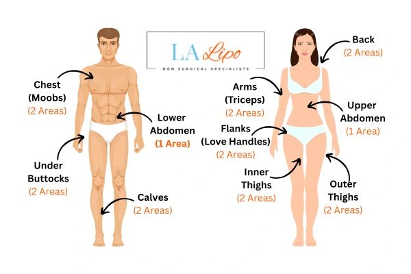 LA LIPO Cryolipolysis Areas Newcastle upon Tyne