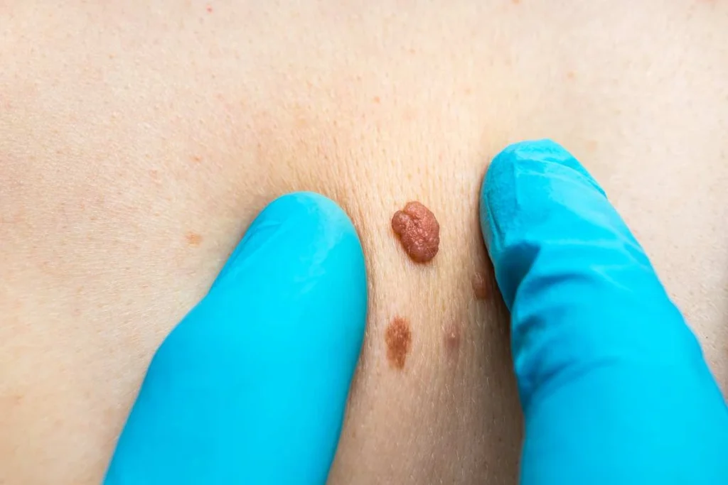 LA LIPO Cryopen Lesion Removal Prices Newcastle upon Tyne