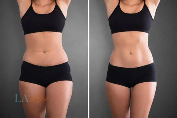 before and after results of non-surgical treatment to help a woman's body image and mental health Newcastle upon Tyne
