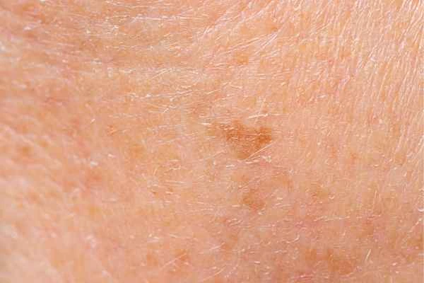 close up picture of age spots Newcastle upon Tyne