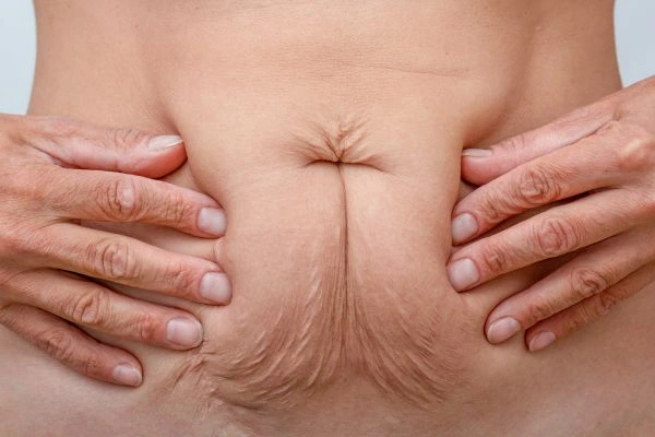 Image of a woman's stomach with loose skin - example of skin tightening Newcastle upon Tyne options